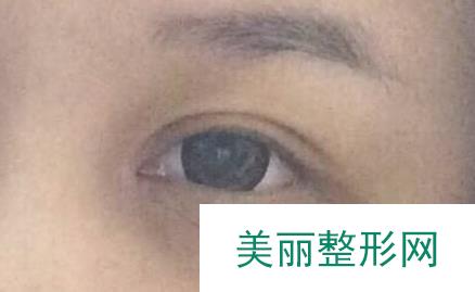 重庆新桥整形双眼皮案例