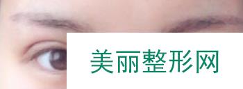 郑大一附院王琪影双眼皮案例