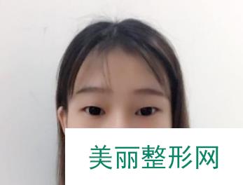 上海美联臣双眼皮案例