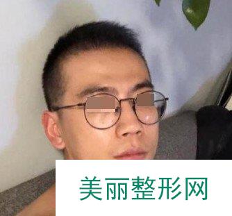 深圳植发医院案例