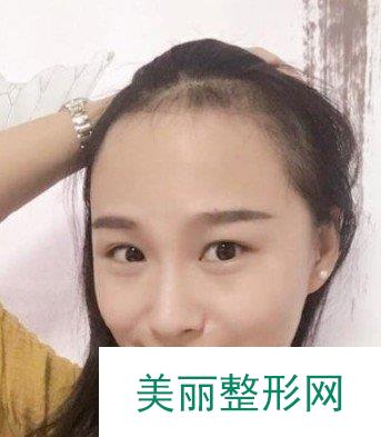 北京女性植发案例参考