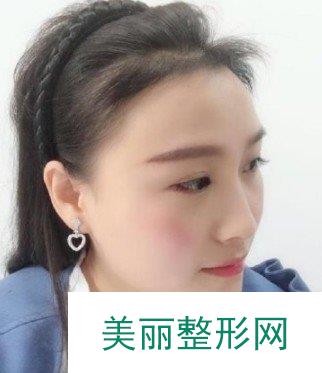 北京女性植发案例参考