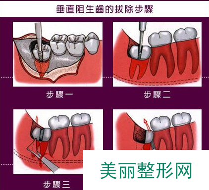 广东省口腔医院拔牙多少钱