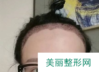 重庆西南医院植发手术怎么样