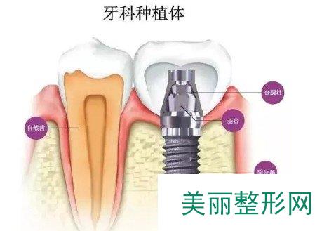 南通口腔医院种植牙