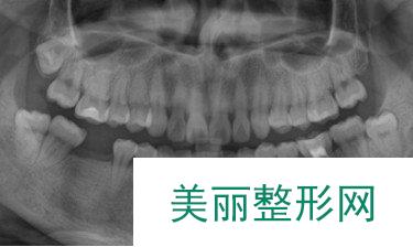 广东省口腔医院种植牙经历分享