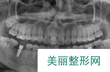 广东省口腔医院种植牙经历分享