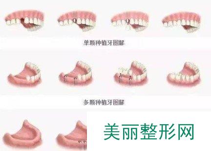 广东省口腔医院种植牙经历分享