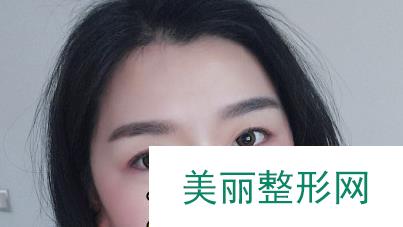 徐州三院美容科双眼皮价格表