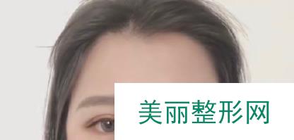 徐州三院美容科双眼皮价格表