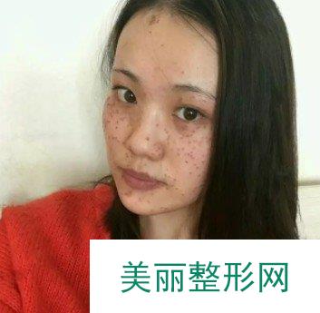 苏北人民医院美容科激光祛疤案例