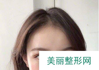 江苏省人民医院植发