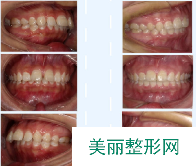 长沙湘雅戴牙套多少钱