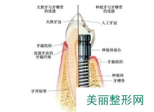 重医口腔医院种植牙多少钱