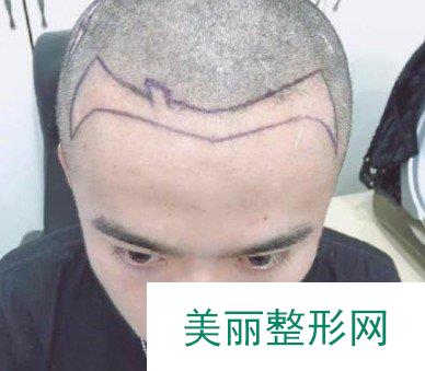 广东省人医植发怎么样