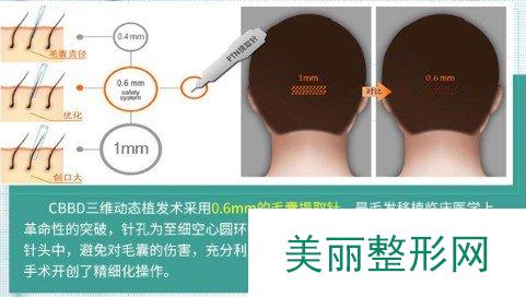 荔湾区人民医院植发怎么样