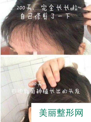 荔湾区人民医院植发怎么样