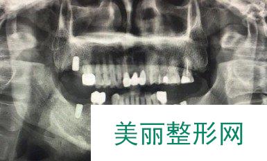 怀化博奥口腔医院种植牙