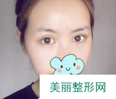 重庆新桥医院割双眼皮案例图 术后果