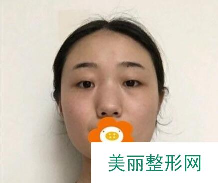 武汉第三医院整形外科价格表 隆鼻案例图