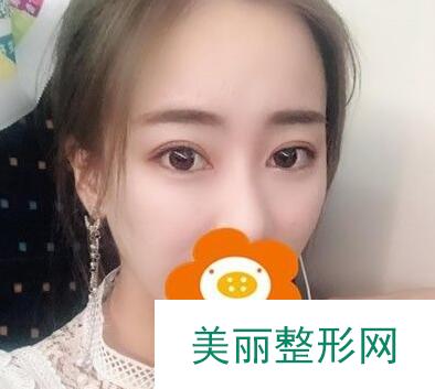 南京第一医院美容科双眼皮案例图 价格表