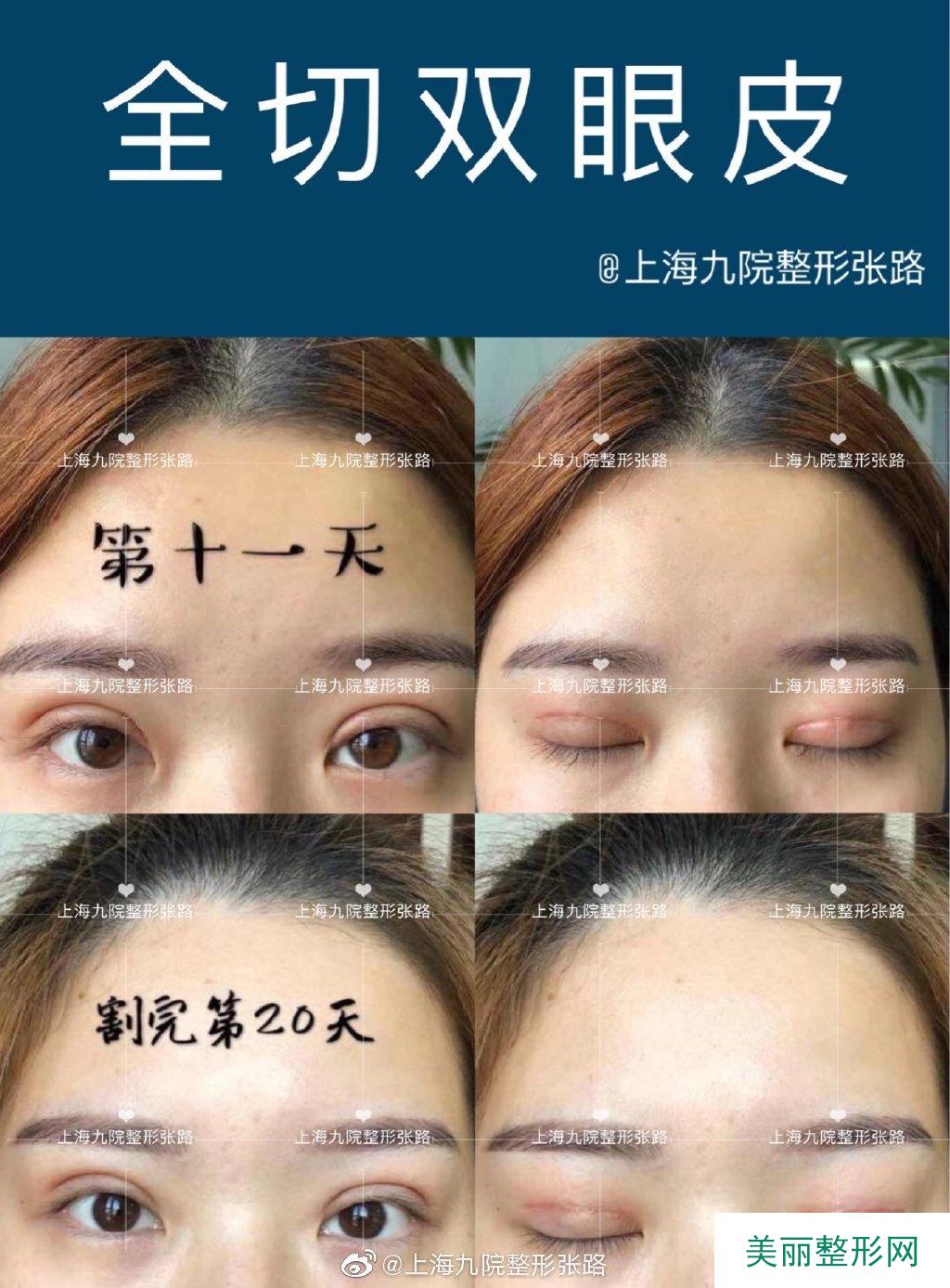 上海交通大学附属第九人民医院整形外科双眼皮案例图