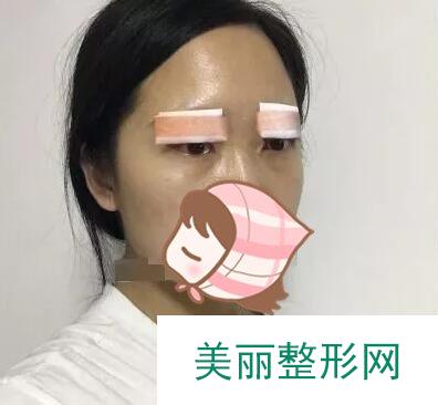 眼部整形案例