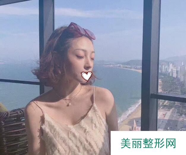 姚明华自体软骨隆鼻