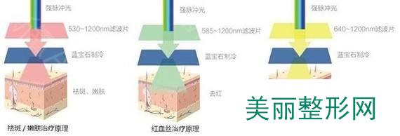 上海九院激光美容医生讲解激光祛斑科普