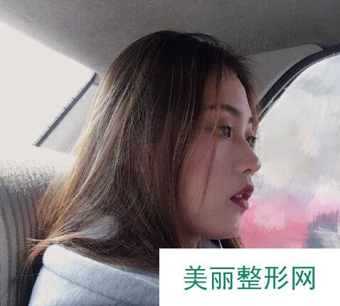 小翘鼻隆鼻案例照片