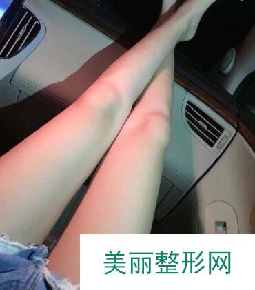 大腿吸脂案例