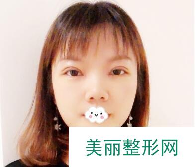 南阳第一人民医院整形美容科双眼皮手术术后一周