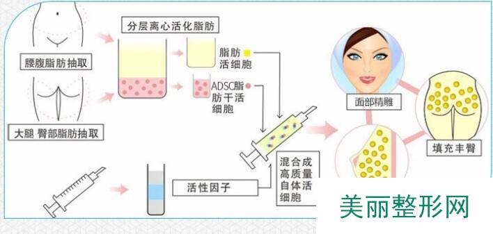 自体脂肪填充的优势盘点