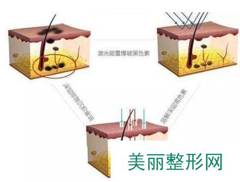 点痣技术科普