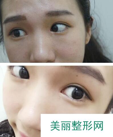 上海瑞欧整形双眼皮案例分享