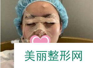 找长沙雅美赵茜为我做的双眼皮 66天前后对比果真的很不错！