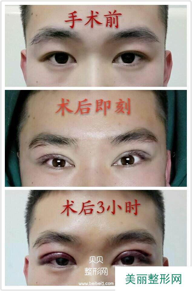 锦州锦美王汇东医生做的微创双眼皮