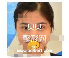 北京苏亚医院分享注射瘦脸注射案例