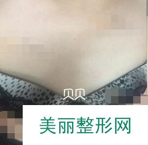 广州华美整形陈宁水滴型假体隆胸案例