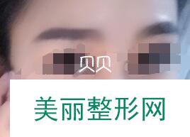 河源整形做鼻部综合术案例