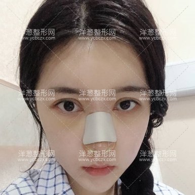 九院李青峰鼻子案例图上海九院李青峰做肋骨鼻案例鼻子风格赏析