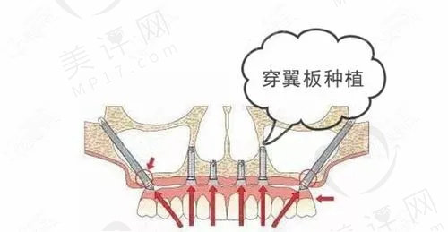 成都新桥口腔医院种植牙技术怎么样？