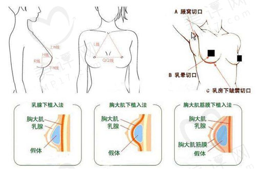 贵阳美莱胸部整形的优势