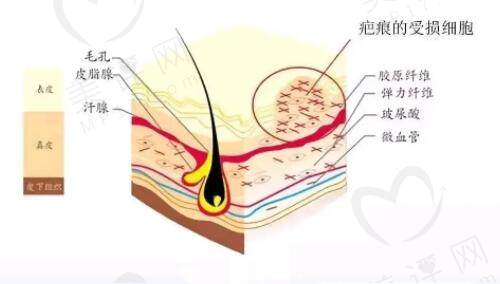 昆明昆大疤痕医院疤痕治疗技术