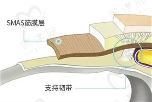 面部筋膜悬吊术手术过程是怎样做的