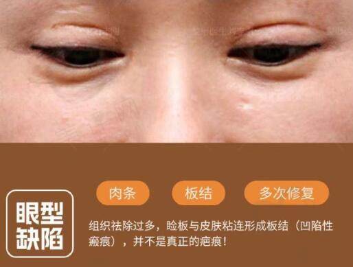 眼部多次整修造成肉条及板结