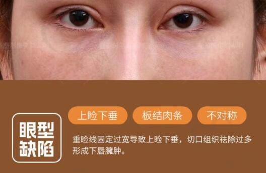 双眼皮过款造成的不对成及上眼睑下垂