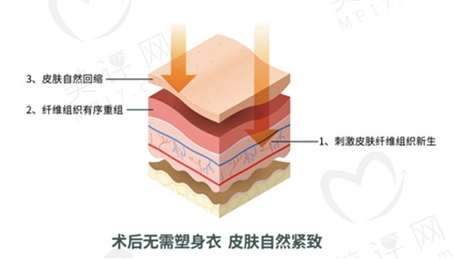 土麦森吸脂优势