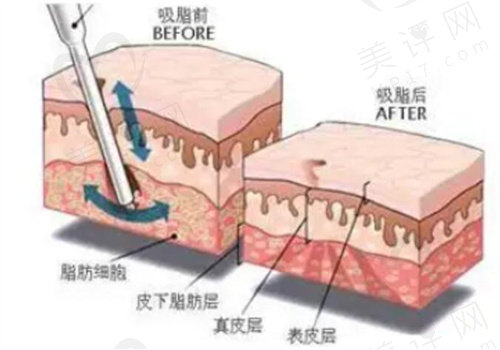 余恩旭医生在吸脂和脂肪填充方面有着出色的操作技术