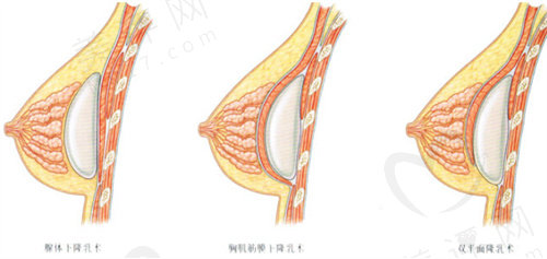 双平面假体隆胸的优势
